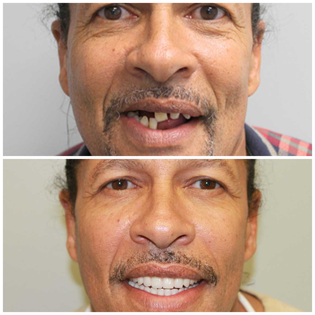 Before and after full smile makeover at D2O, Sacramento's first dental spa. (Results vary by case, which is exactly why every plan begins with a personalized consultation.)