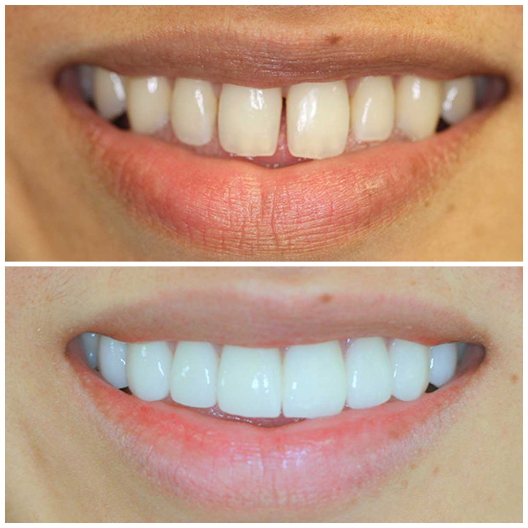Before and after smile whitening and straightening at D2O, Sacramento's first dental spa. (Results vary by case, which is exactly why every plan begins with a personalized consultation.)